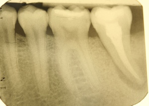 Abb. 8: Patient, männlich, 26 Jahre, Nichtraucher.
Abb. 8a: Zahnfilm 37 vom 29.08.2012, klinische Diagnose:Längsfraktur.