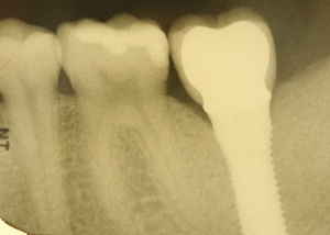 Abb. 8: Patient, männlich, 26 Jahre, Nichtraucher.
Abb. 8b: Zahnfilm 37 vom 15.08.2013 unmittelbar nach eingliederung der Vollkeramikkrone.