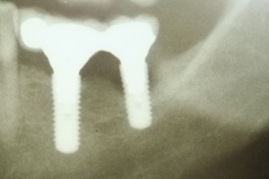 Abb. 13: Patient, männlich, 48 Jahre, Periimplantitis vier Jahre nach Implantation: Zahnfilm regio 36/37.