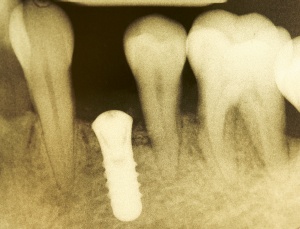 Abb. 18: Patient, m, 32 Jahre, Diagnose: Generalisierte aggressive Parodontitis (siehe Abb. 3).
Abb. 18 b: Zahnfilm nach Implantation 24.10.2012.