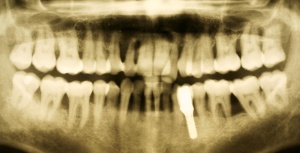Abb. 18: Patient, m, 32 Jahre, Diagnose: Generalisierte aggressive Parodontitis (siehe Abb. 3).
Abb. 18 c: Panoramaschichtaufnahme vom 04.04.2013