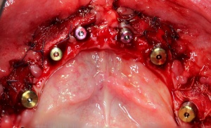 Abbildung 4: eingeheiltes Beckenkammtransplantat.