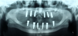Abbildung 6: PSA: Z.n. Freilegung der Implantate im Ober- und Unterkiefer.
