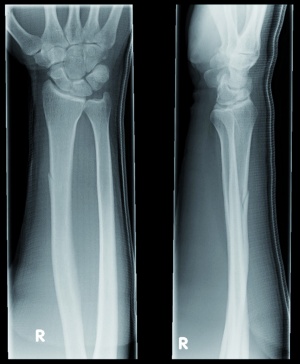 Abb. 3: Röntgenaufnahme des rechten Unterarmes in zwei Ebenen mit radiologischem Frakturnachweis