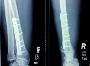 Abb. 4: Röntgenaufnahme des rechten Unterarmes in zwei Ebenen zur Verlaufskontrolle drei Monate postoperativ