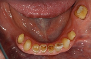 bei noch unbeschliffenen Zähnen müssen die Nachbarzähne aus Platzgründen etwas stärker präpariert werden