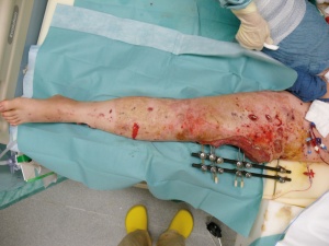 Abb. 4: linkes Bein des Soldaten mit großem Weichteldefekt über der Femurfraktur, Fixateur externe in situ