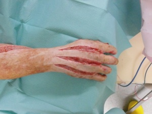 Abb. 1b: Hand mit angelegten Entlastungsschnitten