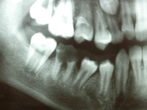 Abb. 1: 14 jähriger Patient: Beginnender perimandibulärer Abszess ausgehend von Zahn 46.