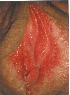 Abb. 2: Vulvovaginal Candidose, Rötung, Epithelschwellung.