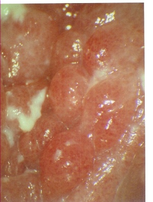 Abb. 4: Introitus vaginae, typ. Bild bei C. albicans, Rötung, Epithelschwellung, flockiger Fluor.