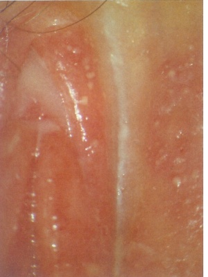 Abb. 5: Vulvitis durch C. albicans, feine Pusteln, starker Fluor.