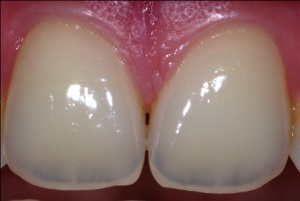 Abb. 1: Gesundes Zahnfleisch ist gestippelt, füllt die Zwischenräume vollständig aus und blutet bei Berührung nicht. Die Zähne sind belagfrei.