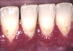 Abb. 2: Entzündetes Zahnfleisch (Gingivitis). Erkranktes Zahnfleisch ist gerötet, blutet leicht bei Berührung und ist geschwollen.