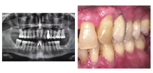 Abb. 5: Implantatversorgung bei Patienten mit früherer aggressiver Parodontitis (15 Jahres-Ergebnis)