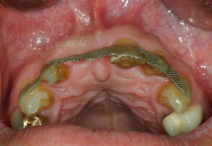 Abb. 1: Schienung des bei dem Unfall subluxierten Zahnes 21