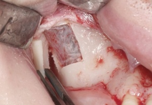 Abb. 6: Intakte Schleimhaut der Kieferhöhle nach Ablösen des Transplantates