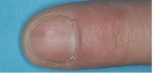 Abb 4: Diskrete streifenförmige Hyperpigmentierung des linken Zeigefinger
