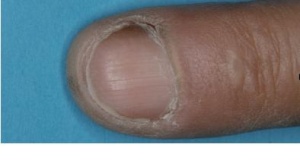 Abb 3: Geringere streifenförmige Hyperpigmentierung des rechten Zeigefingers