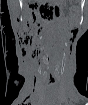 Abb. 2a: Koronare CT-Darstellung der Schildknorpelverletzung und des ausgedehnten Weichteilemphysems