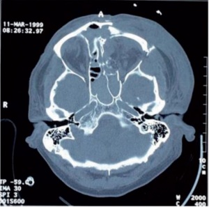 Abb1: axiales CT-Bild einer komplexen frontobasalen Fraktur mit Beteiligung aller Nasennebenhöhlen