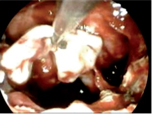 Abb. 3b:von endonasal und eines Duradefektes im Bereich des Keilbeinhöhlendaches über einen endonasalen, transseptalen Zugang