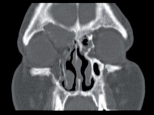 Abb 5: Koronares CT der Nasennebenhöhlen: Posttraumatische Mukozele der rechten Stirnhöhle mit Beteiligung der Orbita