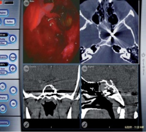 Abb 7: Intraoperative Navigation bei endoskopischer transseptaler Entfernung eines Fremdkörpers (Pistolenkugel) in der Keilbeinhöhle