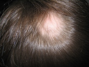 Abb. 6: Alopecia area.: Detail