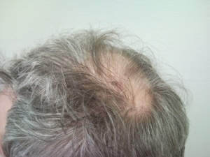 Abb. 2: Androgenetische Alopezie 2°