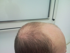 Abb. 3: Androgenetische Alopezie 3°