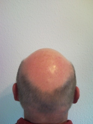 Abb. 4: Androgenetische Alopezie 4°