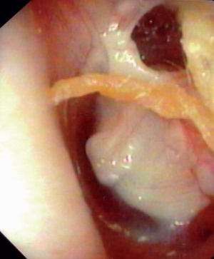 Abb 2: Ohr links, Defekt des hinteren oberen Quadranten, weißliches Transplantat