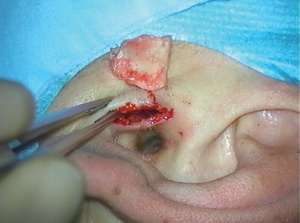 Abb 4: Transplantatgewinnung, Hautschnitt des Tragus und entnommener Knorpel
