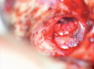 Abb 7: Transplantat (rötlich) und zurückgeschlagener tympanomeataler Lappen (weißlich)
