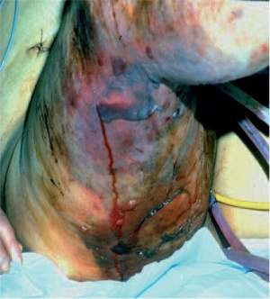 Abb 1: typischer Lokalbefund einer NWTI (dorsolateraler Oberschenkel rechts), in diesem Fall „klassische Gasbrandinfektion“. Foto: Dr. B. Evers