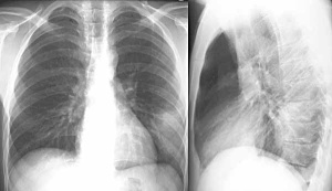 Abb. 3: Lungeninfiltrat im li. Unterlappen bei Q-Fieber-Pneumonie