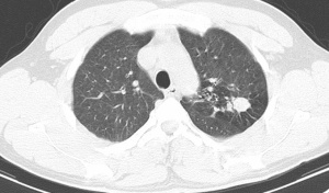 Abb. 4: Infiltrat im dorsalen Segment des li. Lungenoberlappens bei Tuberkulose (typische Lokalisation)