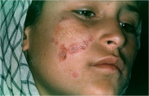 Abb. 8: Hauttuberkulose bei afgh. Kind