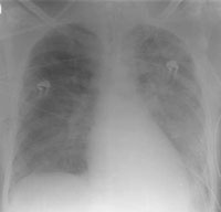 Abb. 9: Rö-Thorax bei blast lung