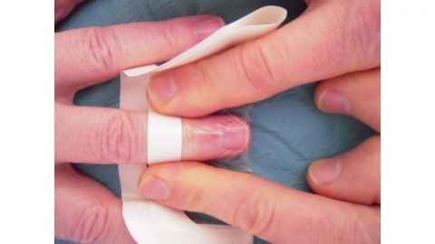 Heilung fingerkuppe abgetrennt Unfall in