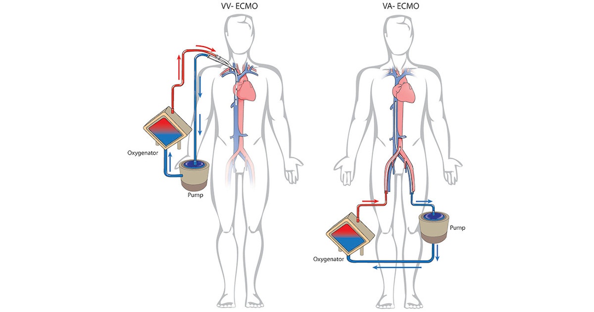 Wehrmedizinische Relevanz der Extrakorporalen ­Membran­oxygenierung (ECMO) • Fachportal für ...