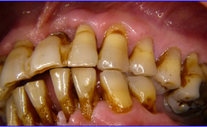 Auswirkungen von systemischen Antibiotika und eines bewusstseinsbildenden Tabakentwöhnungskonzeptes auf die nicht-chirurgische Parodontitistherapie