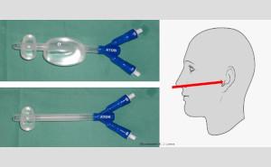 Bedeutung der Kopf-Hals-Chirurgie bei der Erst- und Folgeversorgung von (einsatzbedingten) Kopf-Hals-Traumata