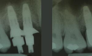 Dentale Implantate zum Ersatz parodontal geschädigter Zähne im Oberkieferseitenzahnbereich