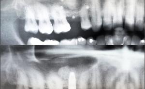 Dentale Implantate im Oberkieferseitenzahnbereich: Komplikationsmanagement bei der Sinusbodenelevation