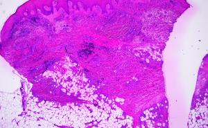 Seltene Ursache einer chronischen Wunde: Kutane Polyarteritis nodosa