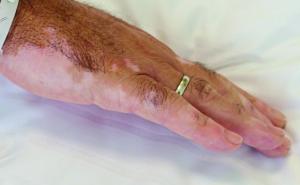 Ruxolitinib – eine neue Hoffnung für Patienten mit Vitiligo