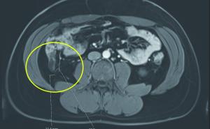Low-grade muzinöse Neoplasie der Appendix – Flankenschmerz in der truppenärztlichen Sprechstunde