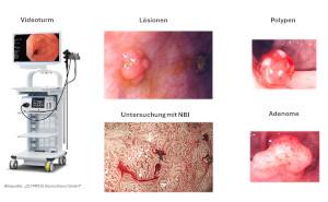 Endoskopische Diagnostik von Kolonläsionen mit KI-Unterstützung